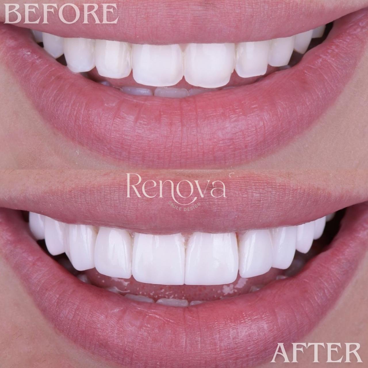 Before and after smile design - female patient