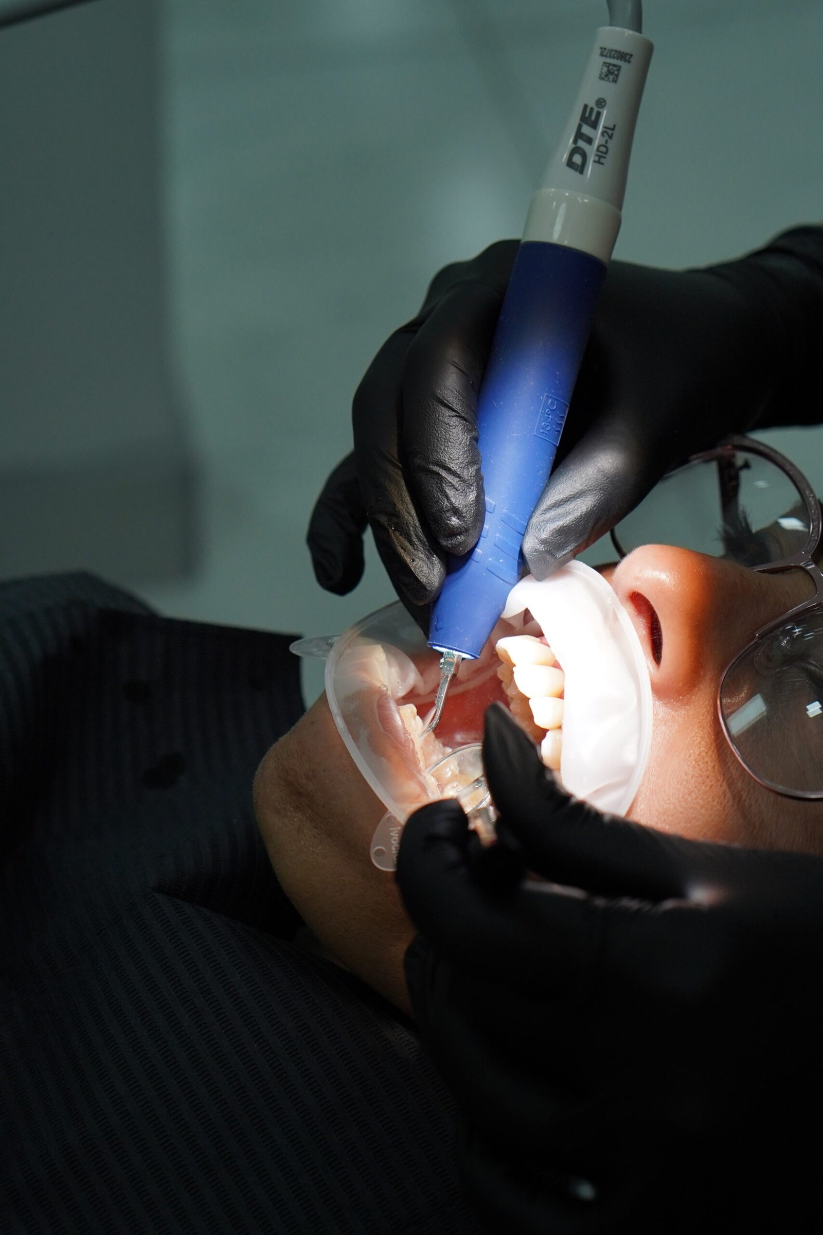 Veneer procedure